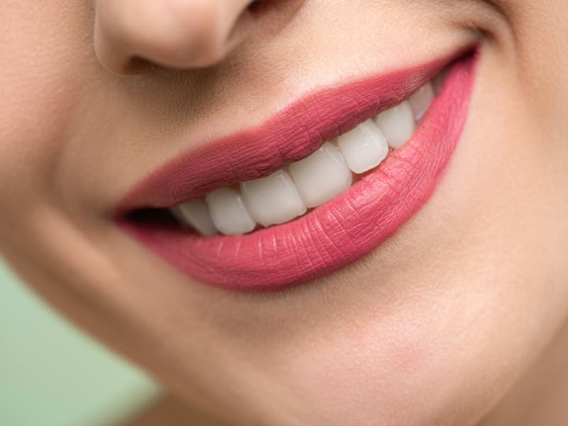 Veneers