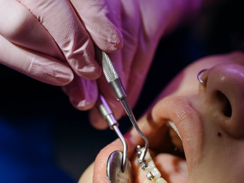 Dental Filling